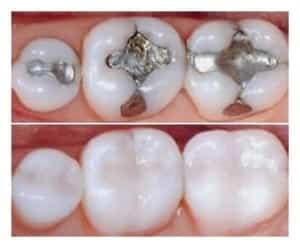 Amalgama - Swissdent Clinica dental en Ica