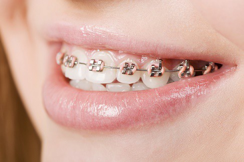Ortodoncia y Brakets