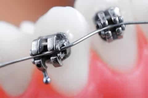 Brackets - dentista Ica