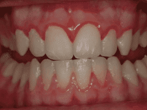 La enfermedad de las encías Odontologo Ica