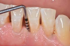 Sonda - Consultorio dental Ica