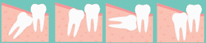 Tercera Molar -Dentista Ica