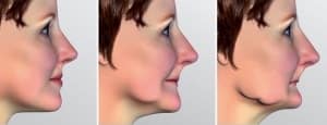 Dentista Ica- perdita dientes