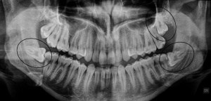 Terecera molar Dentista Ica