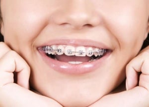 Brackets metalicos - Clinica Dental en Ica