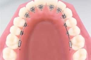 Brackets - Clinica Dental ica