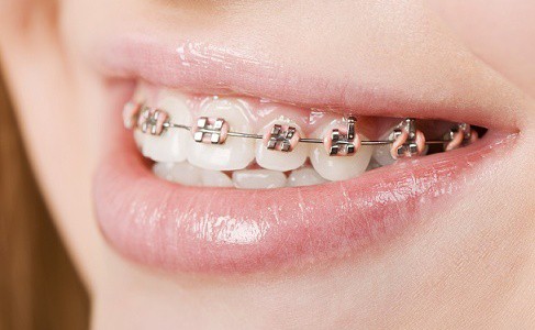 Brackets -Clinica Dental en Ica