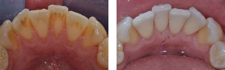 Clinica Dental Ica - Sarro dental