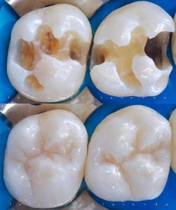 Curaciones blancas - Clínica dental en ica