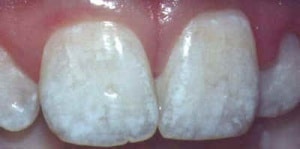Fluor 1- Dentista ica